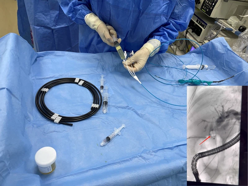 Hangzhou Local Top Three Hospital utilizzando il nostro catetere monouso per ...